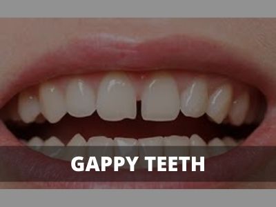 gaps in teeth