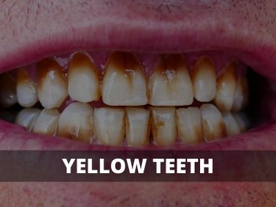 yellow teeth