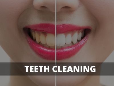 teeth cleaning