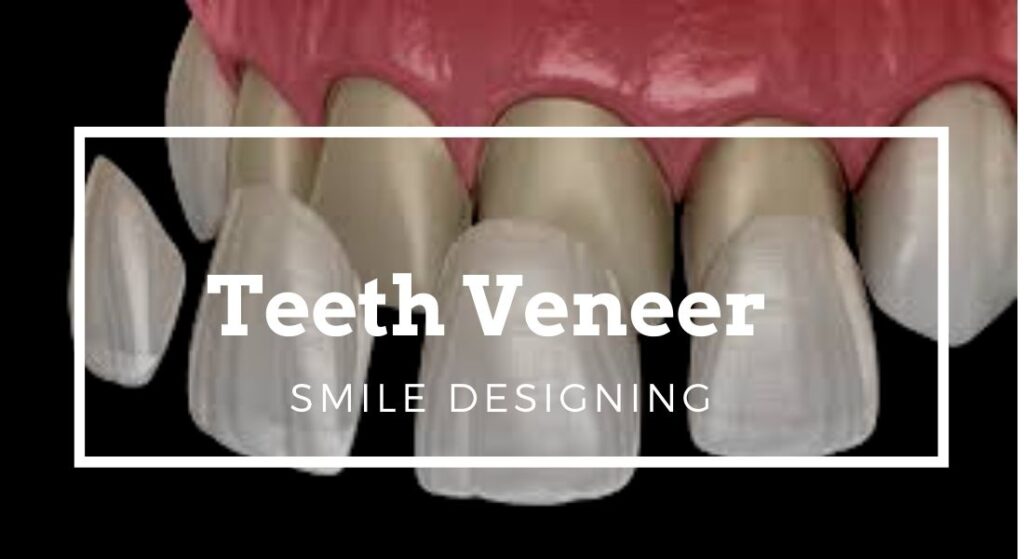 teeth veneer delhi