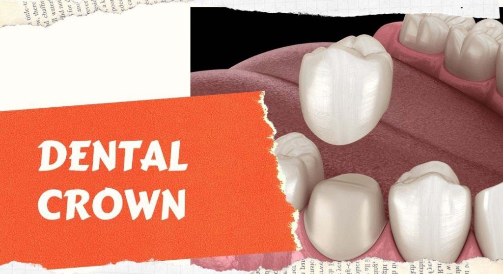 Dental Crown / Cap - Procedure, Type, Benefits , Side-Effect