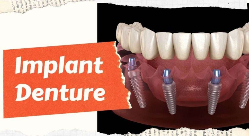 Implant denture cost