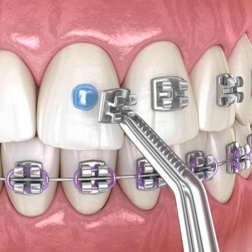 best dental braces rohini