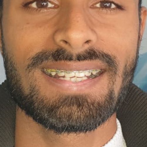 adult orthodontic treatment