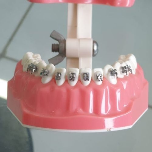 metal dental braces cost