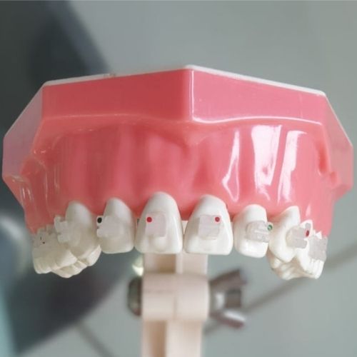 ceramic dental braces delhi