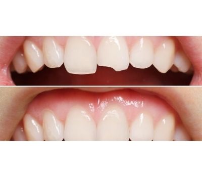 Dental Filling for broken tooth & Chipped tooth