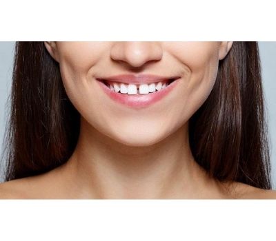 Dental Filling for gap in teeth ​