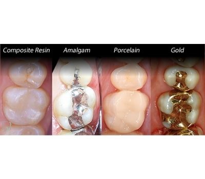Types of Dental Filling or Best Dental Filling.