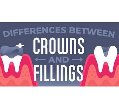 Dental Filling Vs Dental Crown