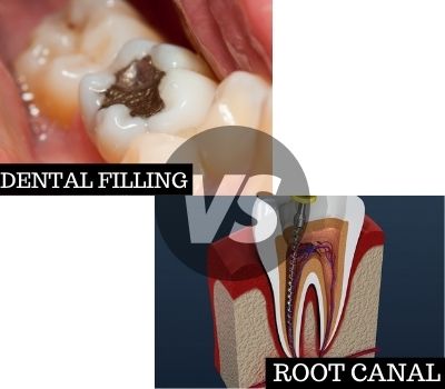 Dental Filling Vs Root Canal Treatment