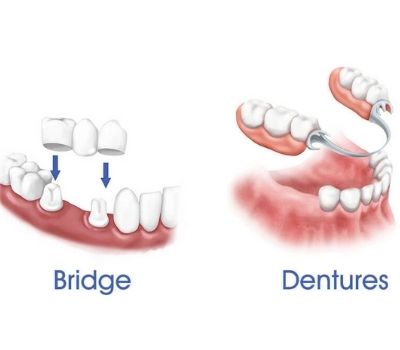 Dental Bridge - Procedure, Uses, Advantage, Disadvantage