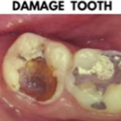 Damage Tooth