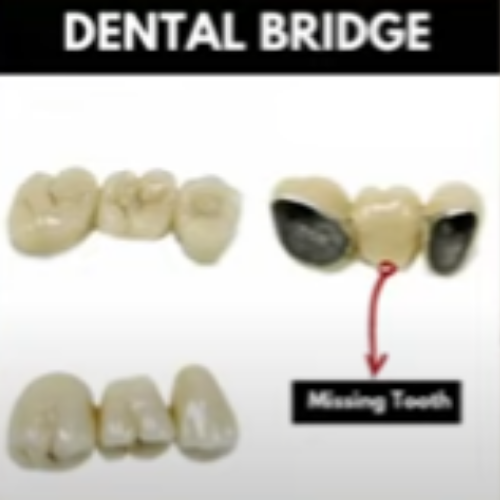 Dental Bridge