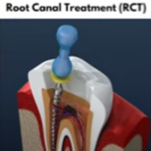 Root Canal Treatment