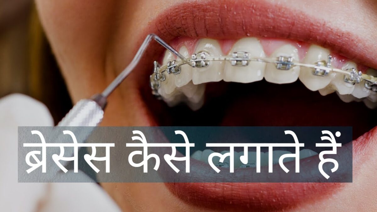 Procedure of Dental Braces