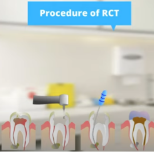 Root Canal Treatment