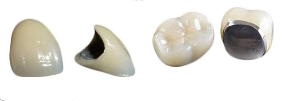 porcelin fused to metal