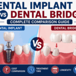 Dental Implant vs Bridge Complete Comparison Guide