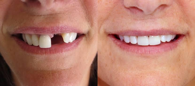 Dental Implant Alternative