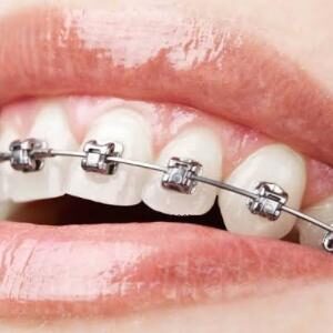 Metal Braces