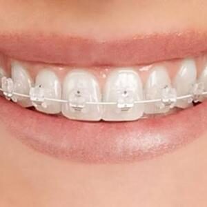 Ceramic braces