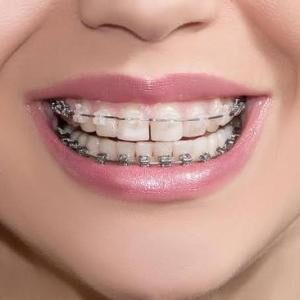 Self ligating braces