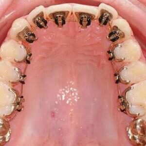 Lingual braces