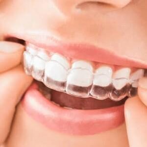 Invisalign braces