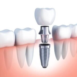 dental implant