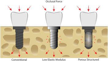 Damage due to excessive force