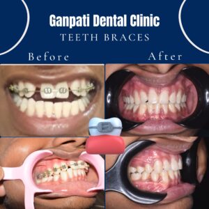 Before and after view braces transformation,