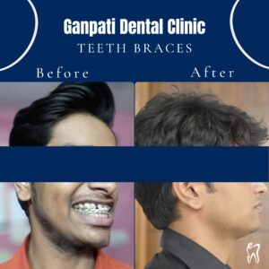 Before and after view of a remarkable braces transformation