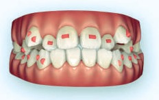 aligners for crowded or crooked teeth