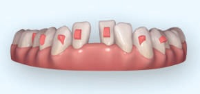 aligners for gap in teeth