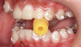seating of aligner
