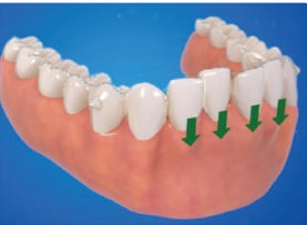 movement of teeth by aligners