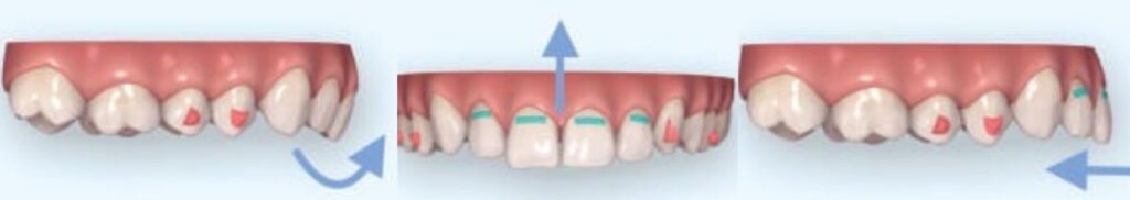 how aligner work