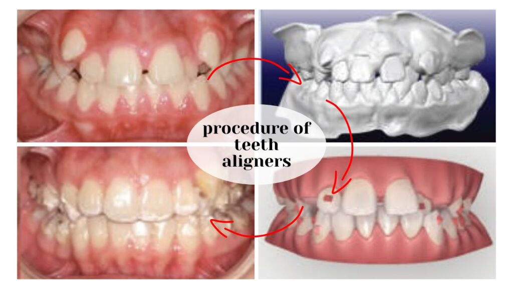 procedure of teeth aligners