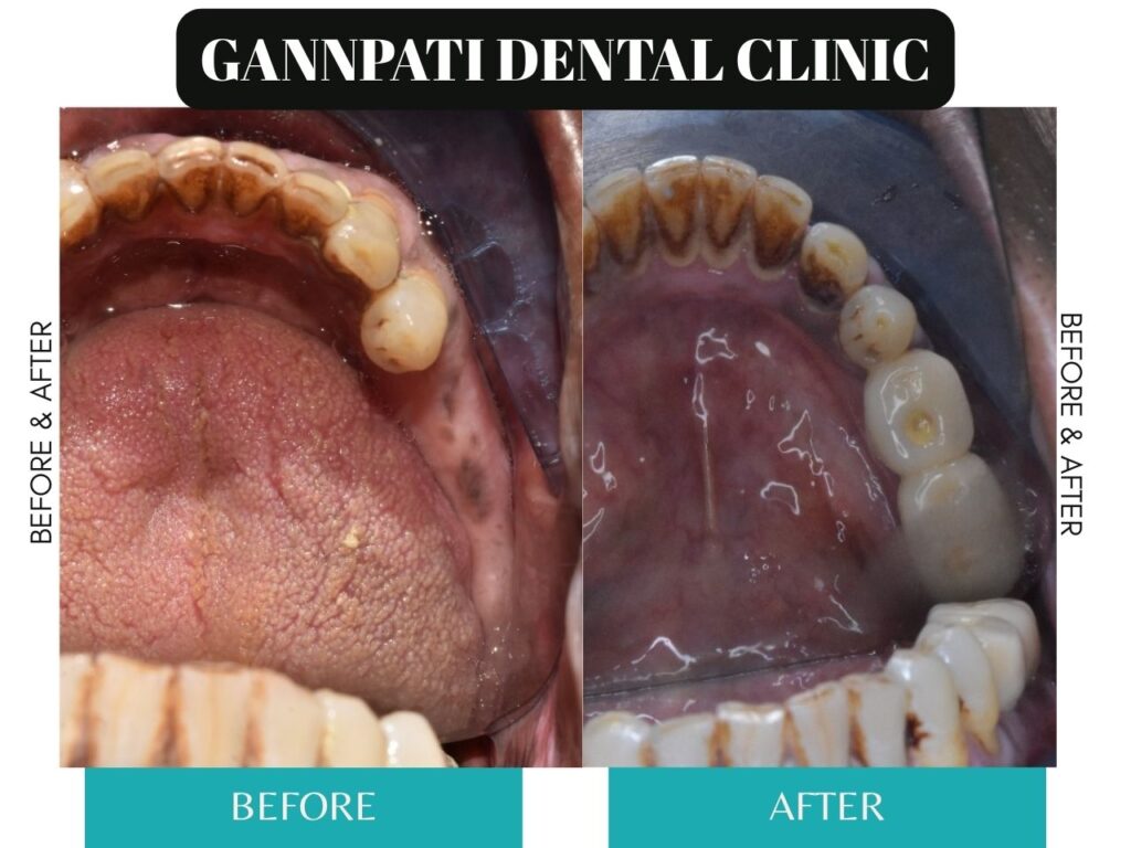 best place for single-tooth implant near rohini