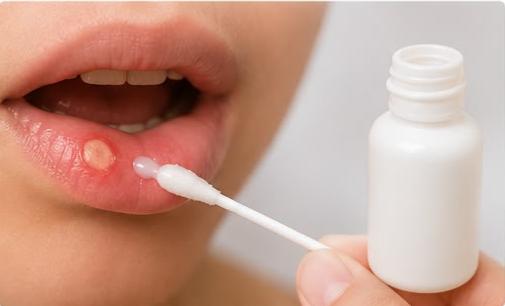 Applying Milk of Magnesia to a mouth ulcer with a cotton swab to protect the sore and promote faster healing.