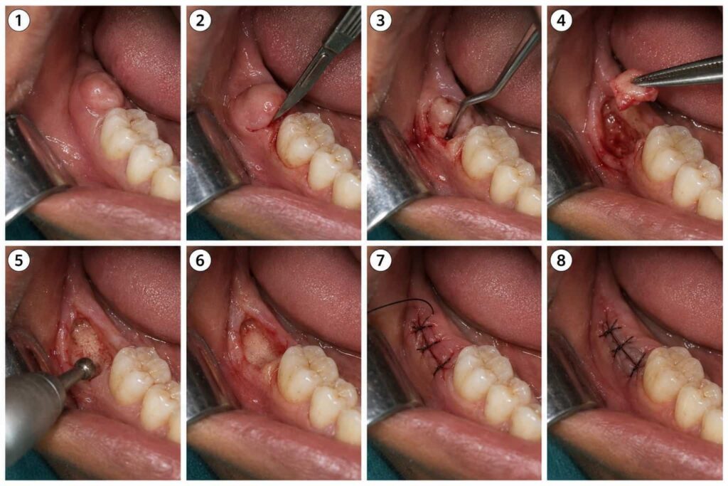Wisdom tooth ke upar inflamed gum flap ko remove karne ki operculectomy procedure