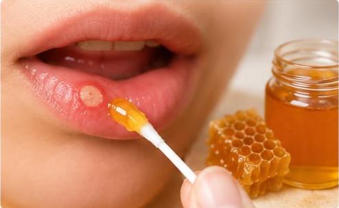 Applying natural honey directly to a mouth ulcer using a cotton swab to help relieve pain and soothe irritation.
