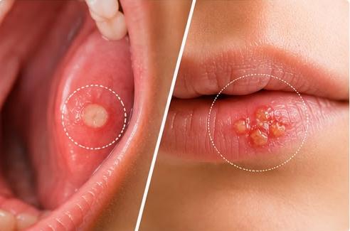 Comparison image showing a canker sore inside the mouth and a cold sore on the lips with highlighted affected areas.