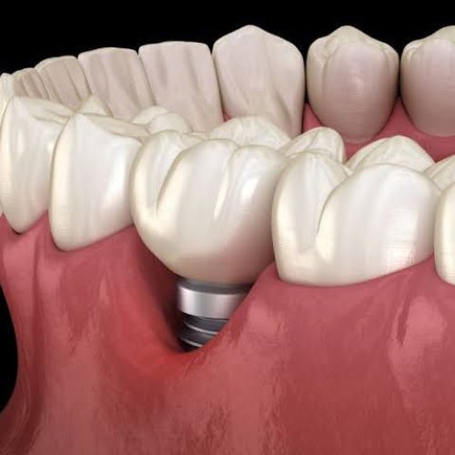 Receding gums or gum recession