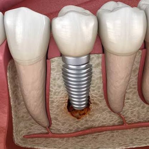 Dental Implant